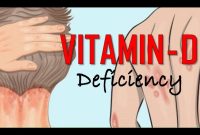 What Are The Symptoms Of Vitamin D Deficiency?