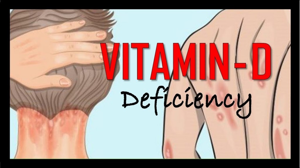 What Are The Symptoms Of Vitamin D Deficiency?